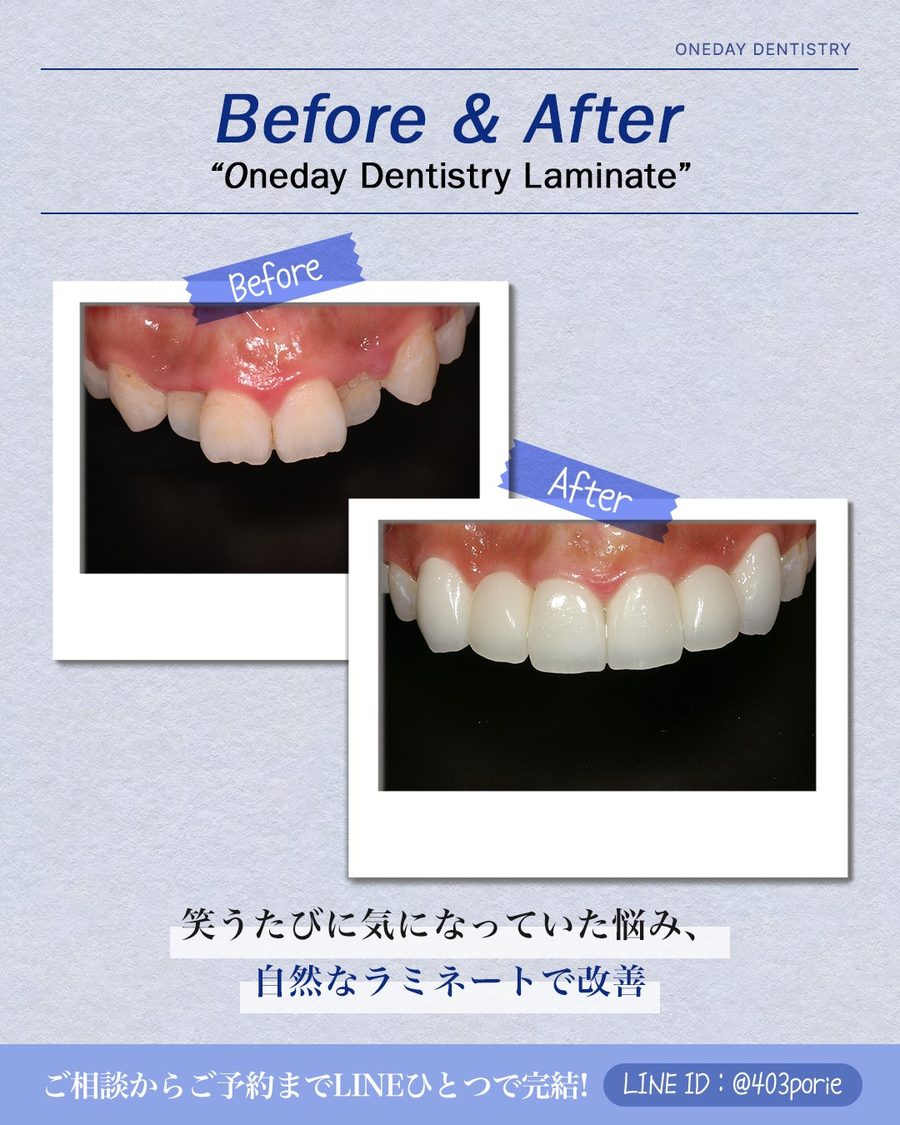韓国式ポーセレンラミネート Before & After 症例1|ONEDAY DENTAL CLINIC